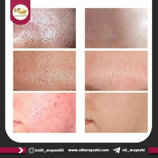 مود ماسک ( ماسک گچی ) صورت کاسه ای انار مویام