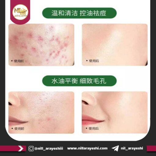فوم شستشو ضدجوش سالیسیلیک اسید بایزتون کد BZT67192